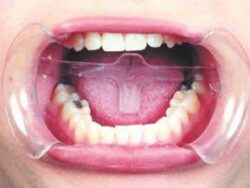 Retractor Large 10,s 2080A